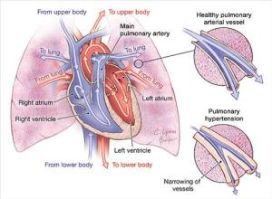 PulmonaryHypertension